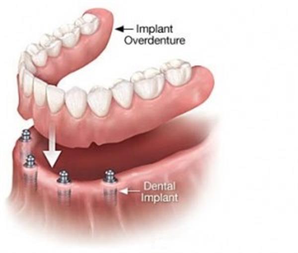 دوره ویژه پروتز دندانی